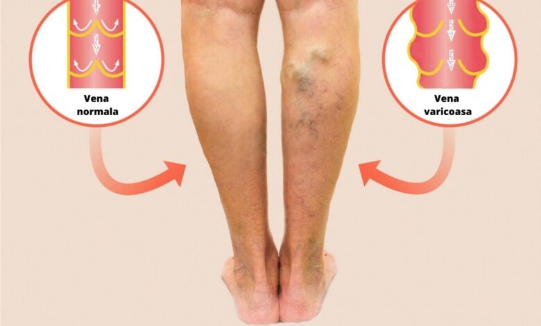 Tratamentul varicelor pe picioare cu remedii populare - Complicații August