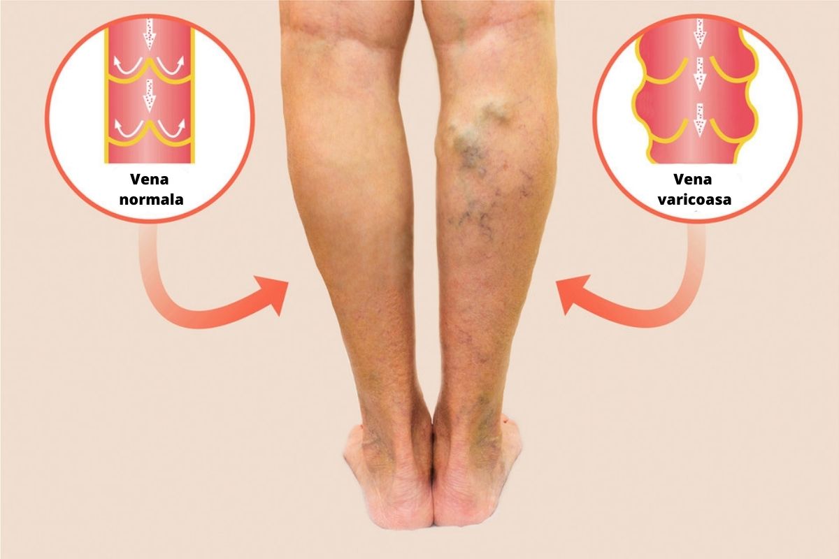 picioarele de hirudoterapie varicoza