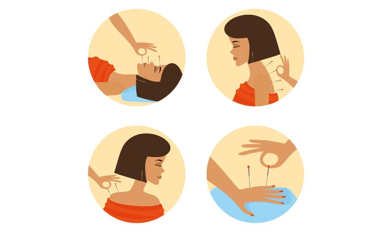 acupunctura beneficii