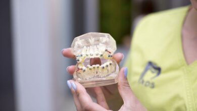 totul despre aparatul dentar